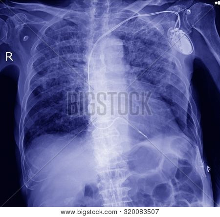 Pacemaker In X-ray Image In Cardiac Catheterization Laboratory