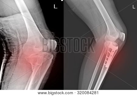 X-ray Knee Joint Fracture Proximal Tibia And Post Fix Fracture Proximal Tibia With Plate And Screws.