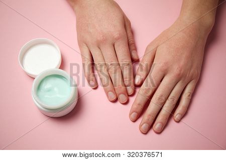 Female Hands Apply Moisturizer To The Skin. Irritation And Allergies, Frostbite.