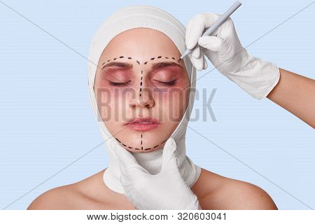Close Up Portrait Of Young Woman With Correction Lines Before Cosmetic Surgery, Wants To Be Beautifu