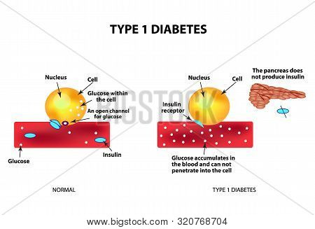 The Absorption Of Glucose By The Cell. Type 1 Diabetes. Increase And Decrease Blood Sugar. Insulin. 