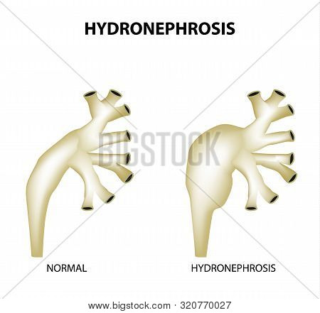 Hydronephrosis. Pelvis. Kidney. Infographics. Illustration On Isolated Background