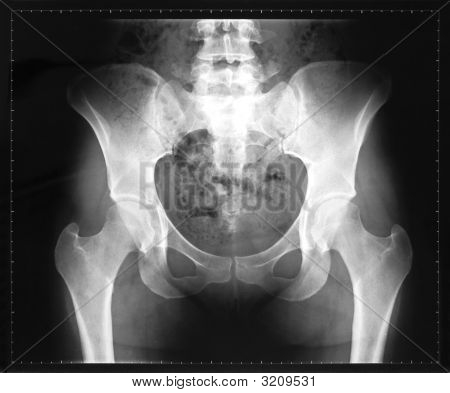 X-Ray van het bekken