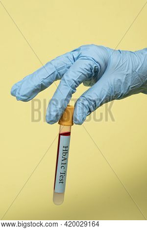 Blood Sample In A Vacuum Tube For Hemoglobin Hba1c Test  Diabetes Diagnosis