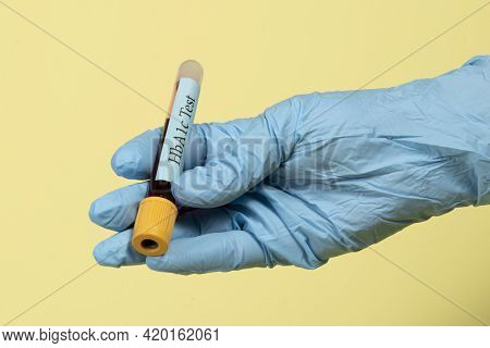 Blood Sample In A Vacuum Tube For Hemoglobin Hba1c Test  Diabetes Diagnosis