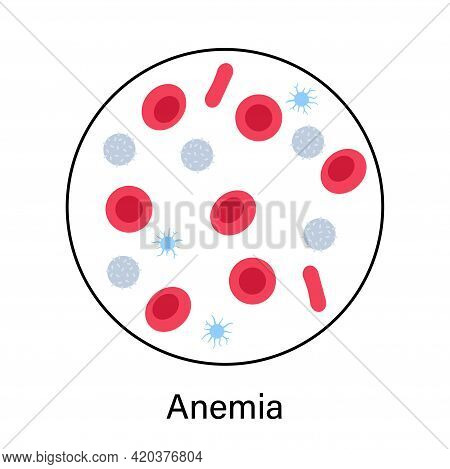 Specimen With Anemia Disease Concept. Human Blood Cells Structure Under Microscope. Microbiology Tes