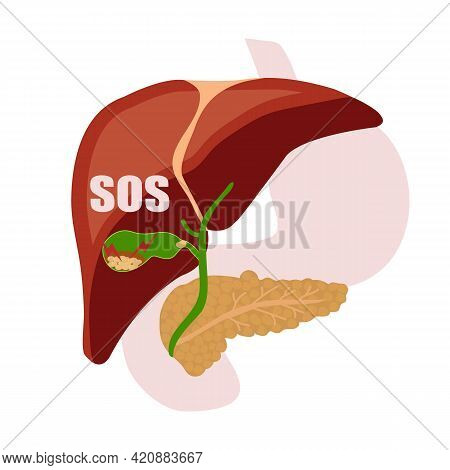 Gallstones. A Fit Of Pain. Digestive Organs. Liver, Pancreas, Gallbladder.vector.