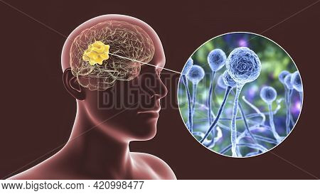 Brain Mucormycosis, A Brain Lesion Caused By Fungi Mucor, Also Known As Black Fungus, With Close-up 