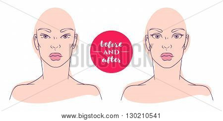 Portrait of a woman before and after with cosmetic defects. Plastic surgery and correction of deficiencies in appearance. Blepharoplasty. Correction of epicanthus, Asian eyelids and drooping eyelids.