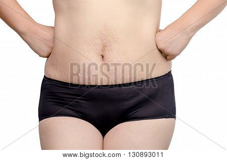 Asian woman showing her stretch marks over white