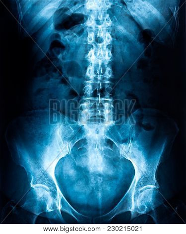 Lumbar Spine X-ray, Lower Back
