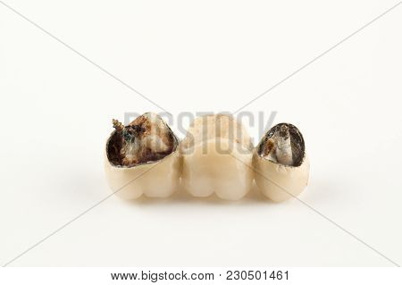 Damaged Cermet Prosthesis With Broken Parts Of Teeth