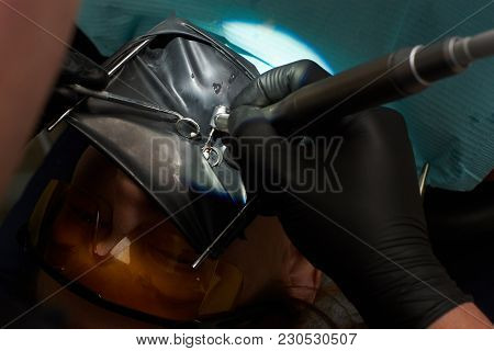 Close-up Of Treatment Of The Tooth Canal With The Use Of A Cofferdam. Dentist In Black Gloves. View