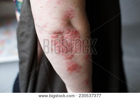 Psoriasis Skin. Psoriasis Is An Autoimmune Disease That Affects The Skin Cause Skin Inflammation Red