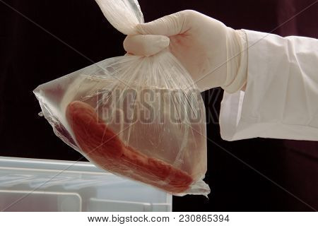 Kidney Transplant Surgery. Illegal Transplantation. Human Cadaver, Donor Organ In Hands Of Surgeon.