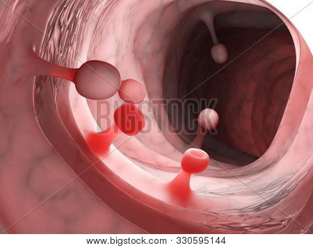 3d rendered medically accurate illustration of colon polyps