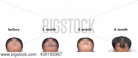 Hair Transplantation Surgery Steps. Patient Before And After The Procedure. Male Hair Loss Treatment