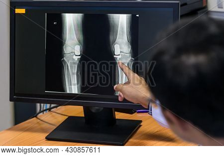 Doctor Pointing On The Knee Problem Point On X-ray Film. X-ray Film Show Skeleton Knee On Film. Surg