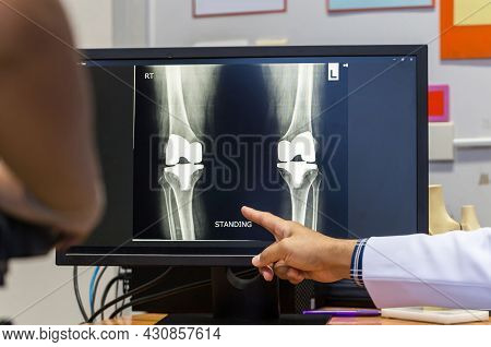 Doctor Pointing On The Knee Problem Point On X-ray Film. X-ray Film Show Skeleton Knee On Film. Surg