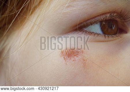 Portrait Girl With An Abrasion Under Her Eye. Child Abuse. Wounds And Abrasions
