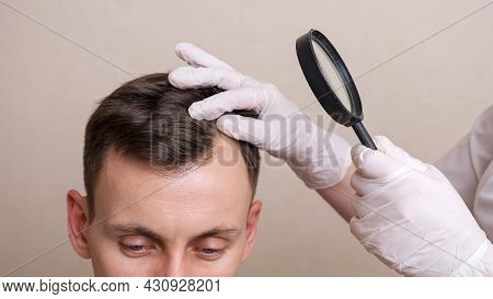 Medical Professional With Gloves And A Magnifying Glass Examines The Head Of A Young Man Closeu.
