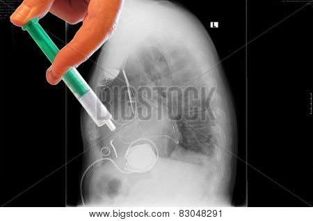 X-ray Image, Links, Artificial Heart Pacemaker