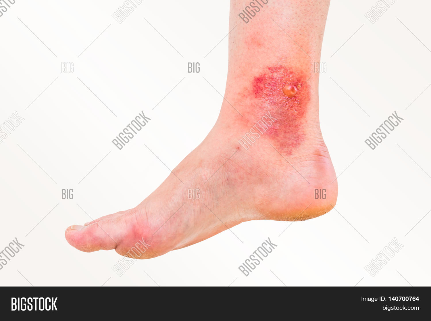 Red Rash On Leg Image & Photo (Free Trial) Bigstock