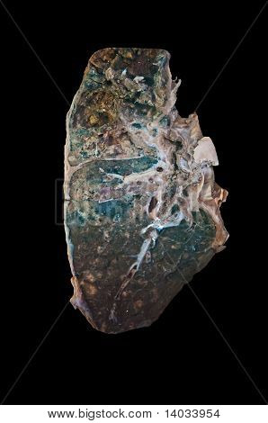 Fibroottisia syvä tuberkuloosi