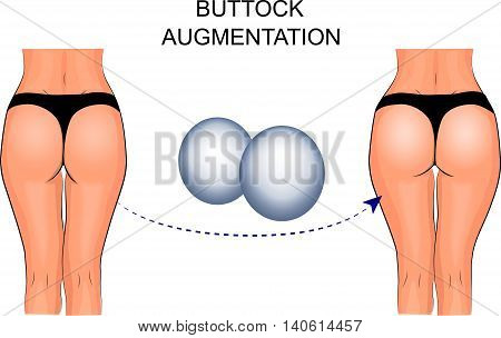 illustration of buttock augmentation.  silicone implant, plastic surgery