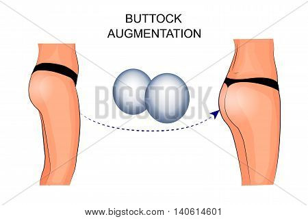 illustration of buttock augmentation. plastic surgery. silicone implant