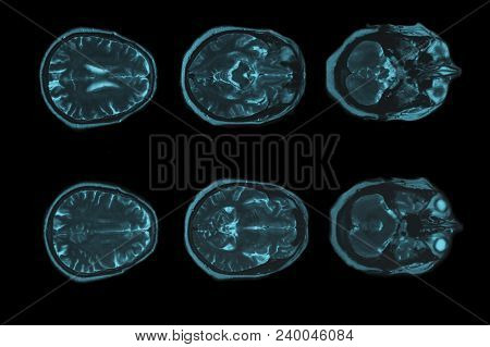 X-ray Image Of The Brain Computed Tomography, Imaging Of The Brain