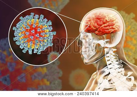 Measles-induced Encephalitis, Medical Concept, 3d Illustration Showing Brain Infection And Close-up 