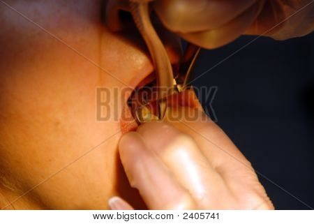 การดำเนินงาน - ฟันแทน