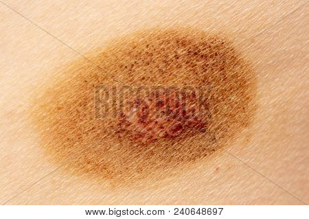 Ringworm On The Human Skin As A Background .