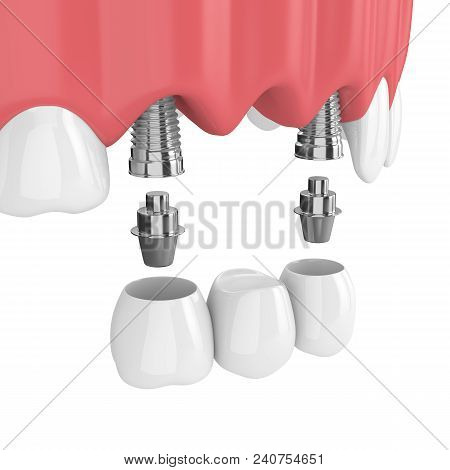 3D Render Of Implants With Dental Bridge In Upper Jaw