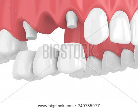 3D Render Of Dental Bridge With Crowns In Upper Jaw