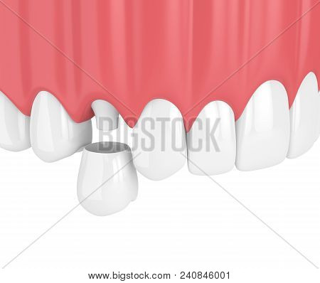 3D Render Of Upper Jaw With Teeth And Dental Premolar Crown
