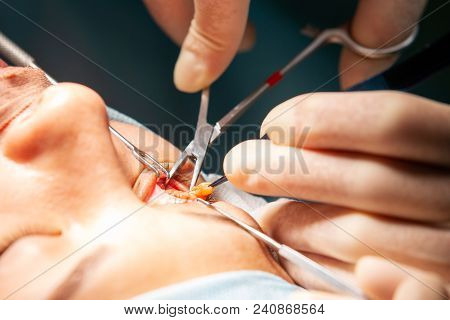Plastic Surgery Of The Eyelid In Operating Room, Blepharoplasty