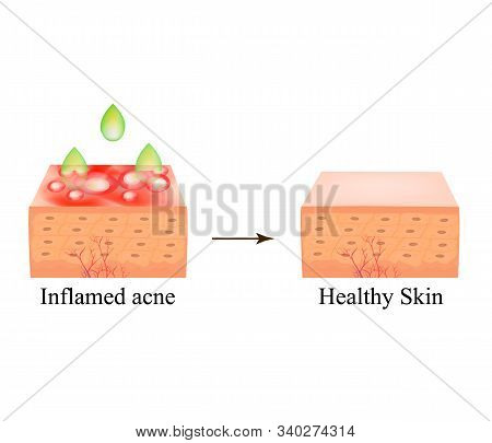 Acne Treatment With Acid Peeling. Inflamed Acne Skin. Pimple Inflamed. Pore Cleansing. The Anatomica