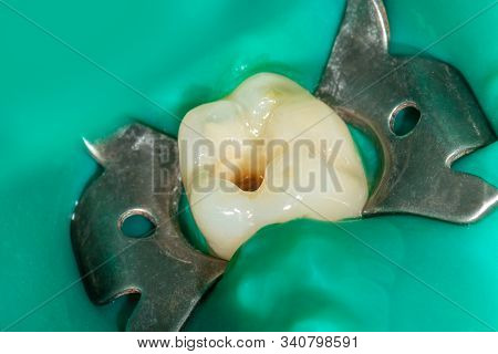 Restoration Of Tooth With Photopolymer Filling Close-up Macro. Caries