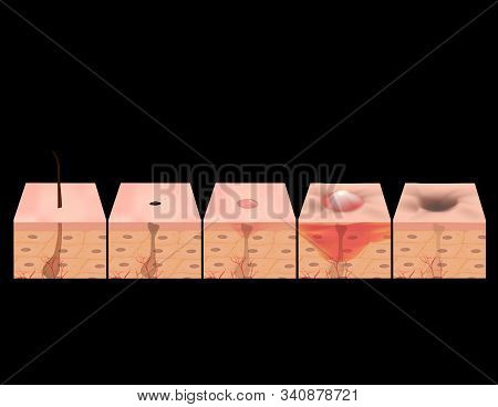 Treatment Of Open Comedones, Inflamed Acne, Acne Cysts. Sore Acne. Structure Of The Skin. Treatment 