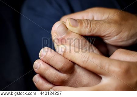 Ingrown Nail On Toe And Painful And Black Background