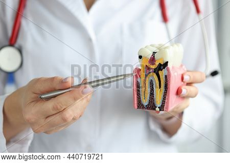Doctor Showing Carious Cavity With Ballpoint Pen On Plastic Artificial Tooth Model Closeup. Dental C