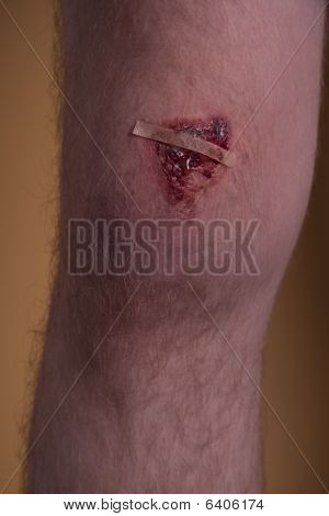 wunde Knie