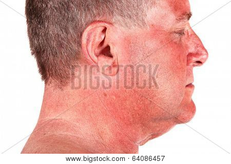 Man with a sunburn