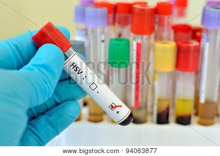 Herpes positive