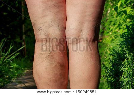 the disease varicose veins on a legs