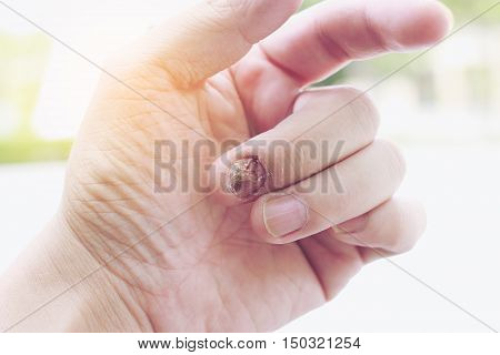 Fungal Nail Infection And Damage On Human Hand. Finger With Onychomycosis