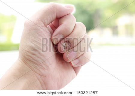 Fungal Nail Infection And Damage On Human Hand. Finger With Onychomycosis