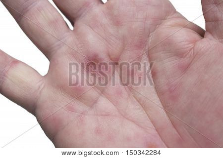 hand foot and mouth disease HFMD palm rash